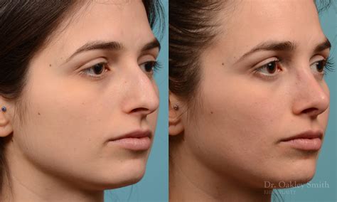 Rhinoplasty Before And After Case 289 Toronto Rhinoplasty Surgery Nose Surgery By Dr Oakley