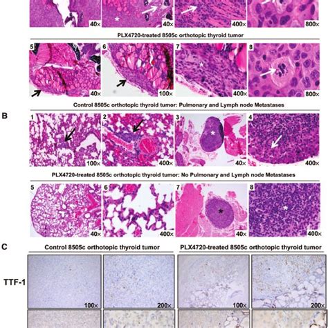 Tumor Growth And Lung Metastasis In An Orthotopic Mouse Model Of Human