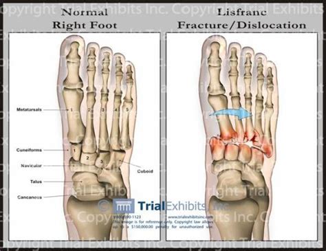 Lisfranc Fracture Lisfranc Injury Foot Exercises Acl Surgery