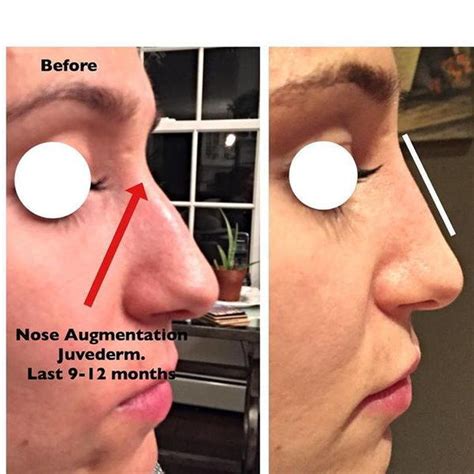 Nose Bridge Augmentation Filler Injectable Rhinoplasty Cost Pics Reviews Qanda