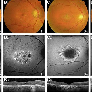 Fundus Photographs Fundus Autofluorescence Faf Images And Foveal