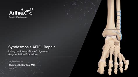 Arthrex Syndesmosis Aitfl Repair Using The Internalbrace™ Procedure