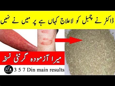 Psoriasis Treatment Chambal Ka Ilaj Bas Ye Khain Chambal Bhagain