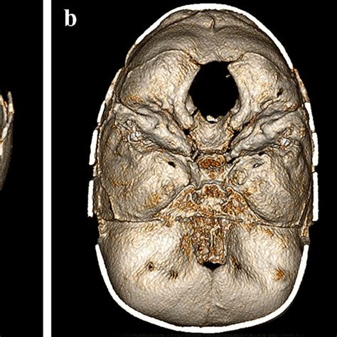 Postoperative Non Contrast Enhanced Computed Tomography Ct Images Of