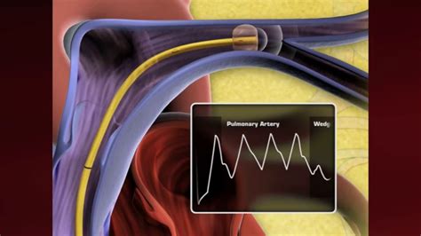 Swan Ganz Catheter Placement Animation Youtube