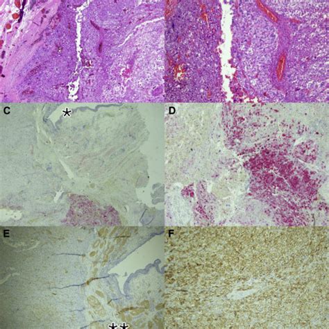 PDF Malignant Perivascular Epithelioid Cell Neoplasm PEComa Of The