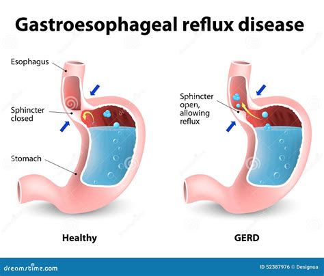 Gastroesophageal Reflux Disease Stock Vector Image 52387976