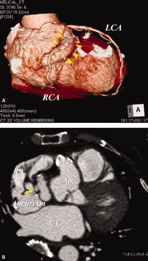 A Three Dimensional Volume Rendering Image Of Mdct Shows Dilatation