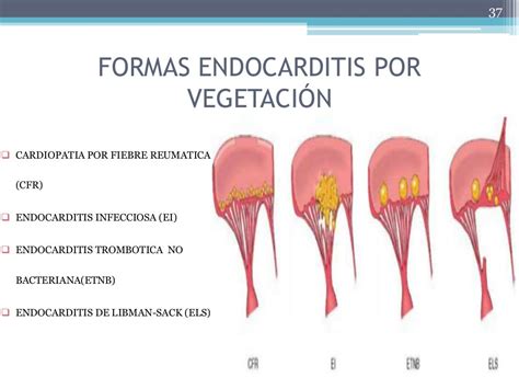 3pericarditismiocarditis Y Endocarditis Patologia Del Corazón