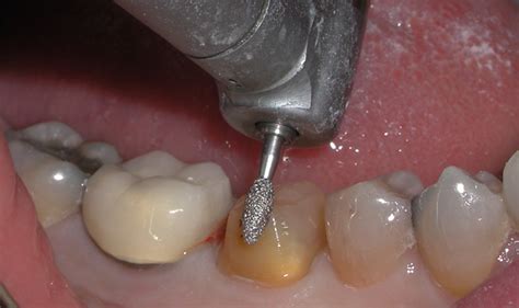 master single unit crown procedures