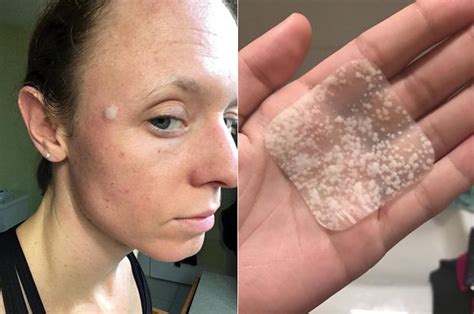 27 Things That Ll Get Rid Of Pimples As Fast As Possible Pimples