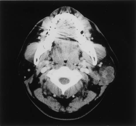 Keratocystoma Of The Parotid Gland A Report Of Two Cases Of An Unusual