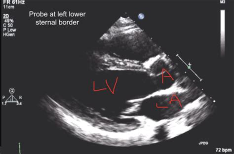 Cardiac Imaging Flashcards Quizlet