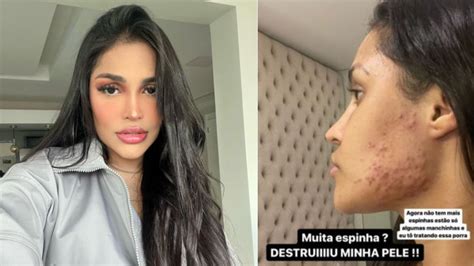 Ex BBB Flay relata efeito adverso após uso de chip da beleza