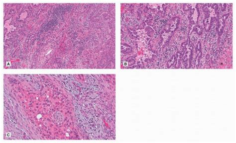 Adenosquamous Carcinoma | Thoracic Key