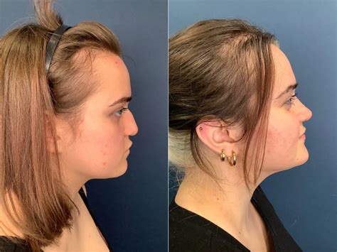 Why Rhinoplasty Results Look Better Over Time Claytor Noone Plastic