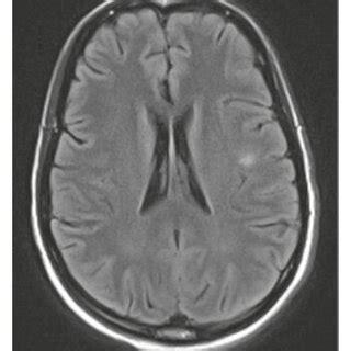 Contrast Enhanced Mrv Of The Brain Is Performed On Day A And Day