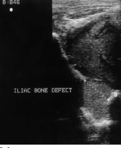 Figure From A Case Report Iliac Bone Tuberculosis With Iliopsoas