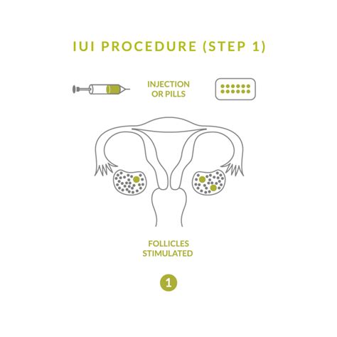 Intrauterine Insemination Iui British Columbia Olive Fertility Centre