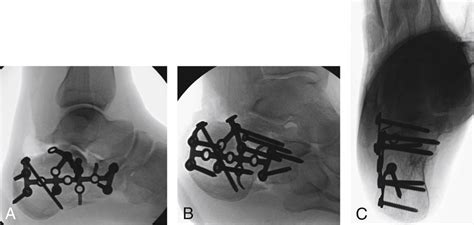 Open Reduction And Internal Fixation Of Calcaneal Fractures