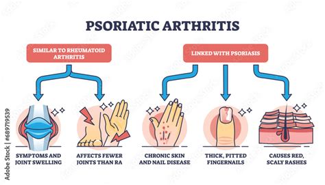 Psoriatic arthritis as chronic dermatological skin condition outline ...