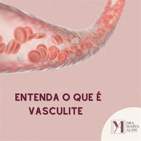 Entenda o que é vasculite Artrite Reumatoide