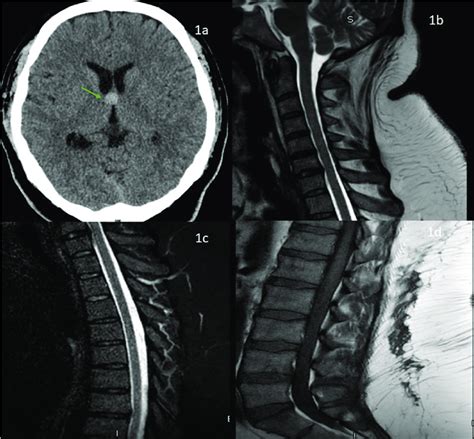 1a Ct Head Showing Colloid Cyst At The Level Of Foramen Of Monroe Download Scientific Diagram