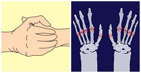 Do You Know The Truth Behind Cracking Your Knuckles This Is