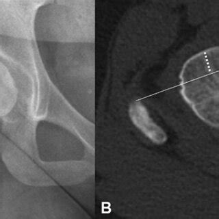 Anteroposterior Radiographs Of The Right Hip Of Dysplastic Hips