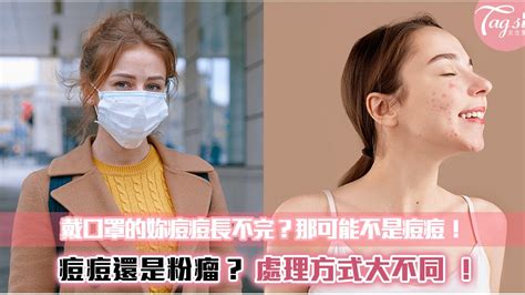 戴口罩長痘痘？──其實它有可能是粉瘤！ Line購物