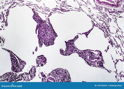 Lung Emphysema, Light Micrograph Stock Image - Image of medicine, microphotograph: 139736291