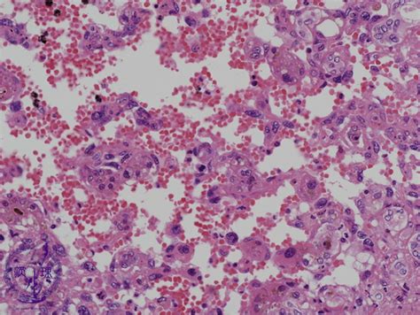 10liver 14 Angiosarcoma Of The Liverpathology Core Pictures