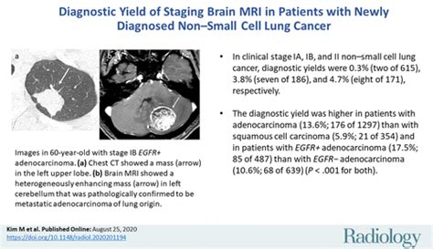 Lung Cancer Mri