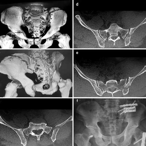 Axial CT section depicting the segmental ilium fracture | Download ...