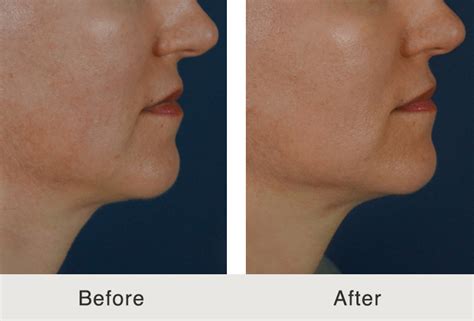 Before & After Fillers to Jawline and Marionette Lines | Carolina Facial Plastics