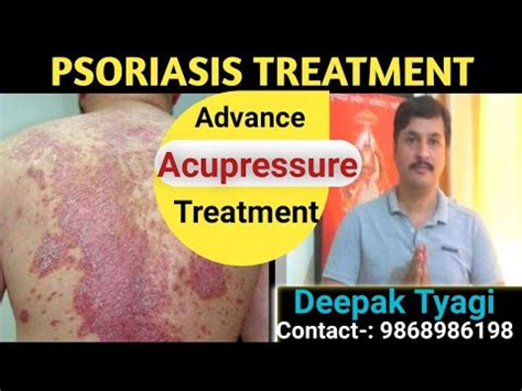 Acupressure points for Psoriasis - YouTube