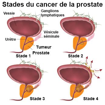 Cancer de la prostate symptômes traitement définition