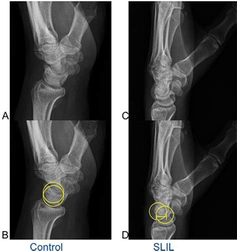 Radiographs Detect Dorsal Scaphoid Translation In Scapholunate