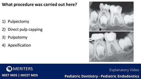 Neet Mds Inicet Pediatric Dentistry Pediatric Endodontics Explanatory Video Meriters