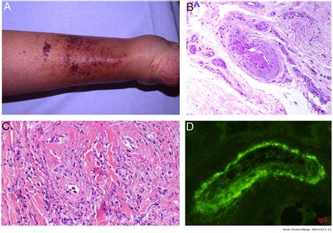 Idiopathic Thrombocytopenic Purpura Histology