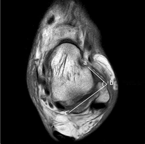 Line ab was drawn parallel to the anterior talofibular ligament (ATFL);... | Download Scientific ...