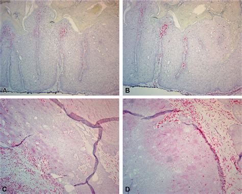 Immunohistochemistry of sebaceous adenoma and carcinoma. In the ...