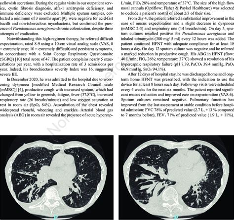 Chest Ct Scan Showing Varicose And Cystic Bronchiectasis With Abundant Download Scientific