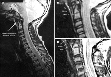 Superior Constrictor Muscle