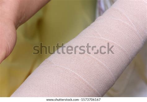 Lymphedema Management Wrapping Lymphedema Hand Arm Stock Photo ...