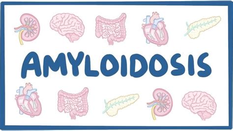 Amyloidosis Ask Hematologist Understand Hematology