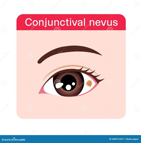 Conjunctival Nevus Vector Illustration Stock Vector - Illustration of ...