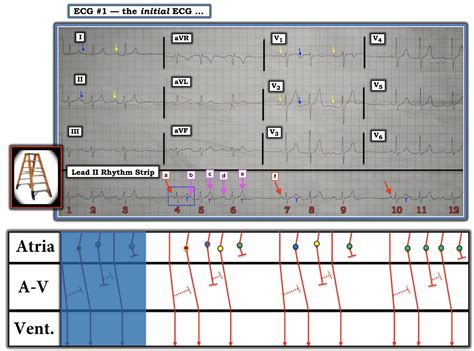 Dr Smith S ECG Blog 40 Something Man With Palpitations And Grouped