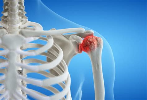 Relieving Shoulder Pain With Suprascapular Nerve Block