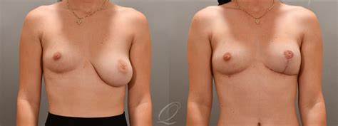 Breast Augmentation With Fat Transfer Before After Photos Patient